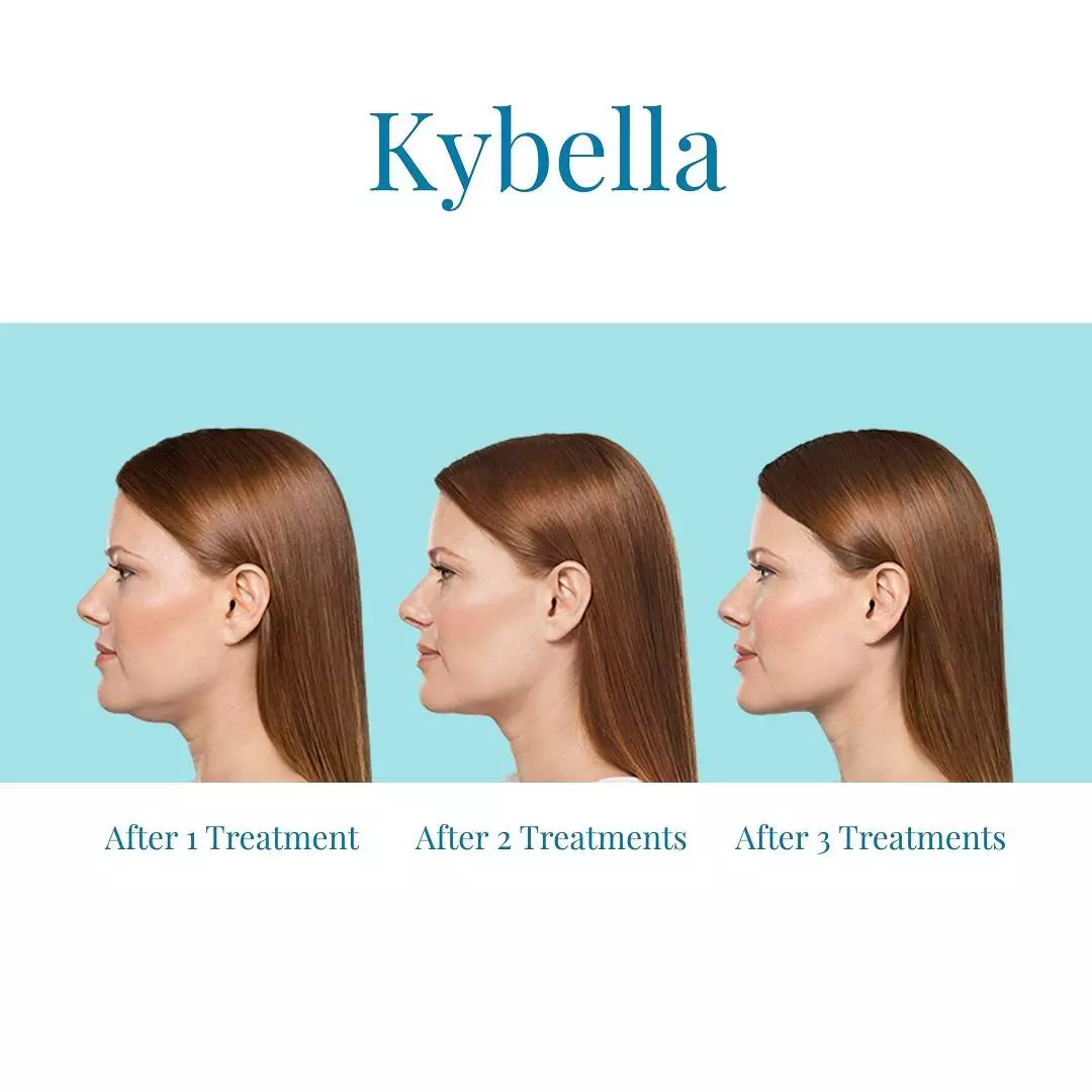 Bella-Medspa-is-the-top-provider-of-Kybella-in-Alpharetta