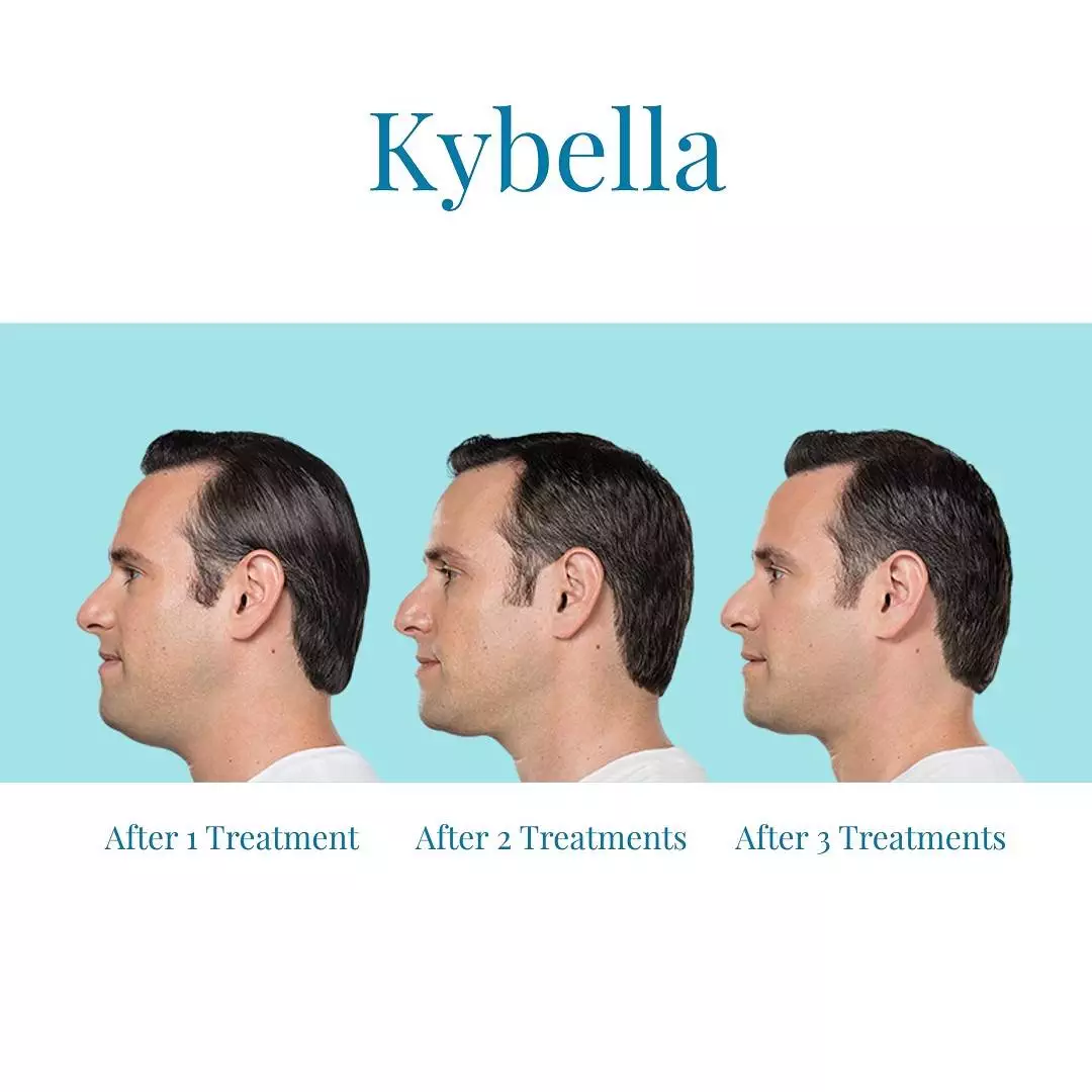 Bella-Medspa-is-the-top-provider-of-Kybella-in-Buckhead