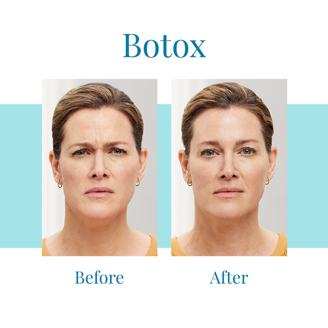 Bella Medspa offers Botox injections in Alpharetta