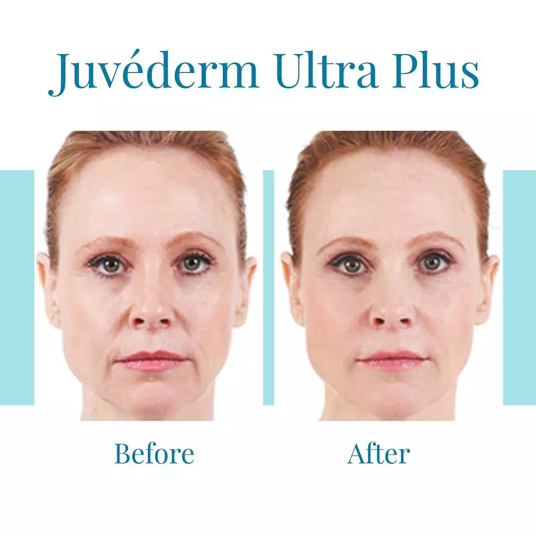 Bella-Medspa-offers-Juvederm-Ultra-Plus-injections-in-Alpharetta