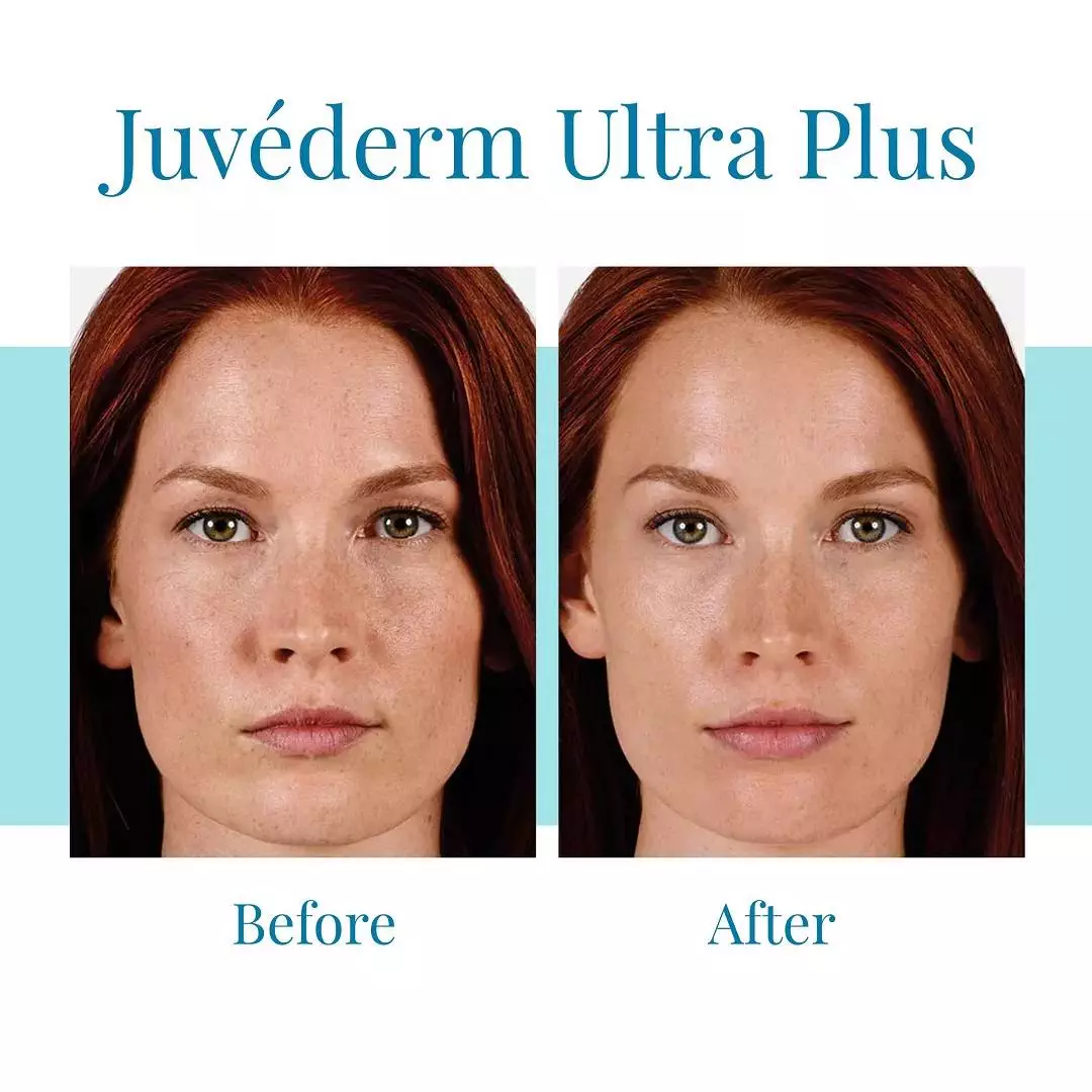 Bella-Medspa-offers-Juvederm-Ultra-Plus-treatments-in-Alpharetta