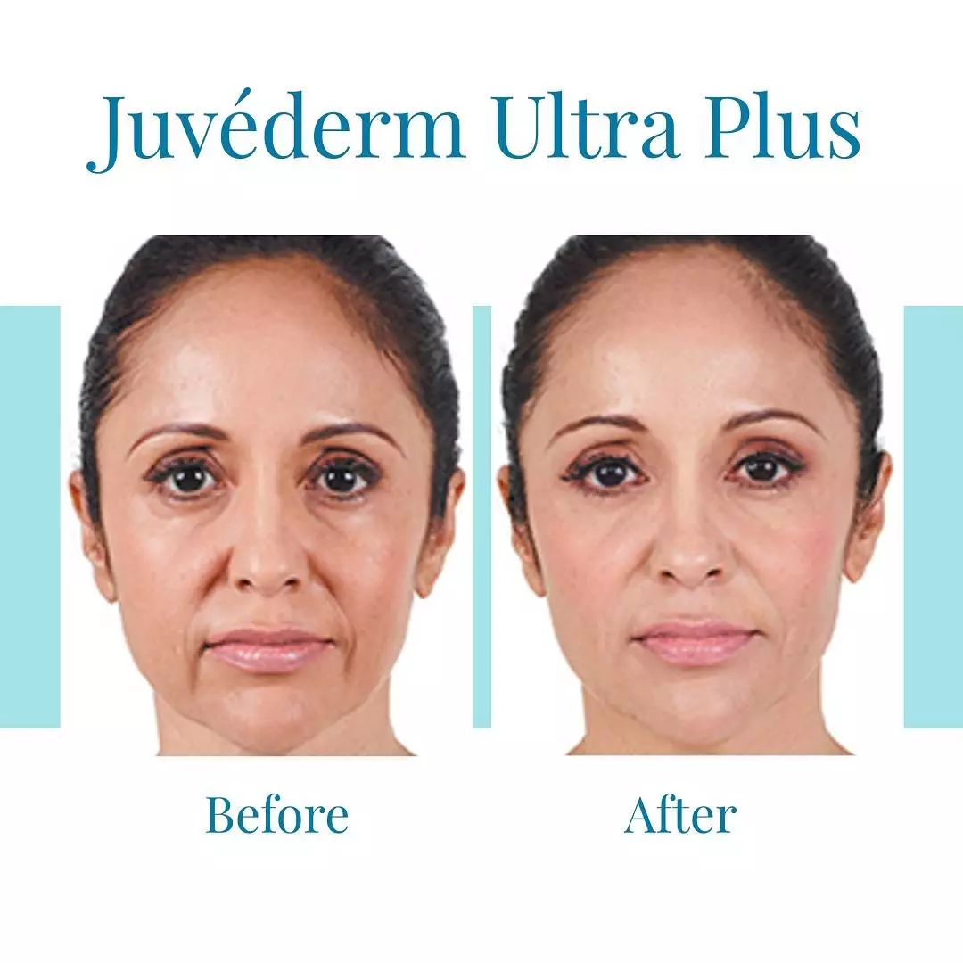 Bella-Medspa-offers-Juvederm-Ultra-Plus-treatments-in-Atlanta