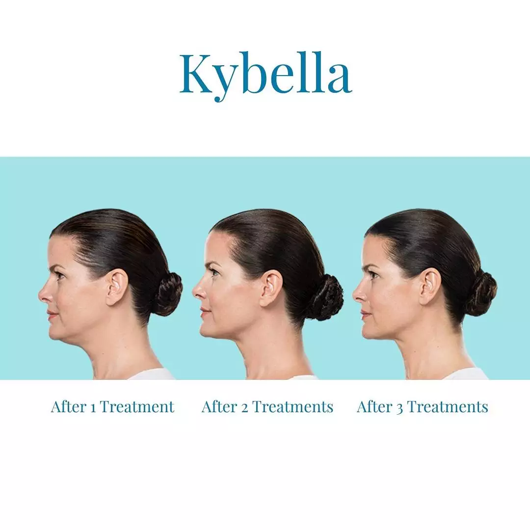 Bella-Medspa-offers-Kybella-in-Alpharetta