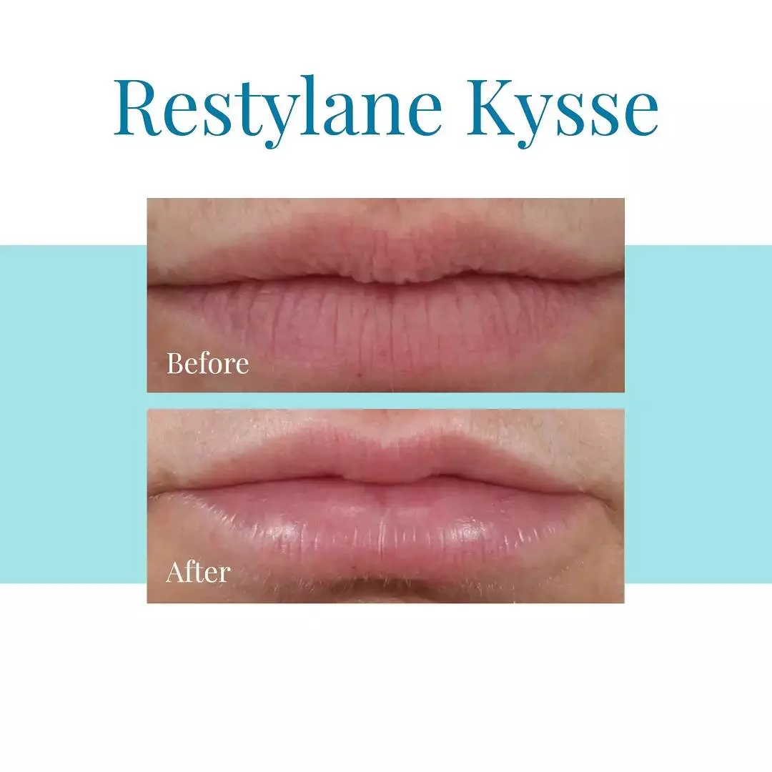 Bella-Medspa-offers-Restylane-Kysse-injections-in-Alpharetta