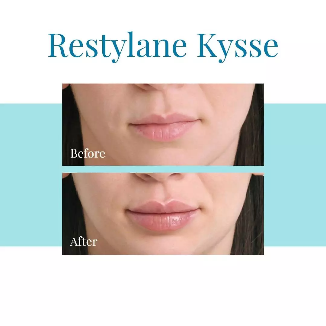 Bella-Medspa-offers-Restylane-Kysse-injections-in-Buckhead