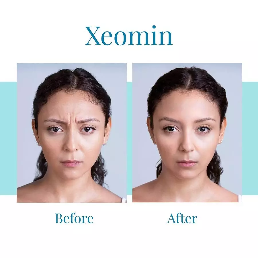 Bella-Medspa-offers-Xeomin-injections-in-Alpharetta