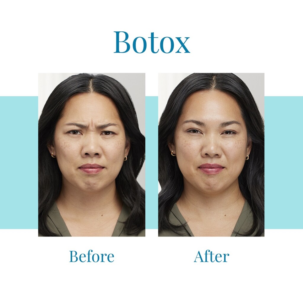 Best Botox Injections » Bella Medspa » Buckhead & Alpharetta