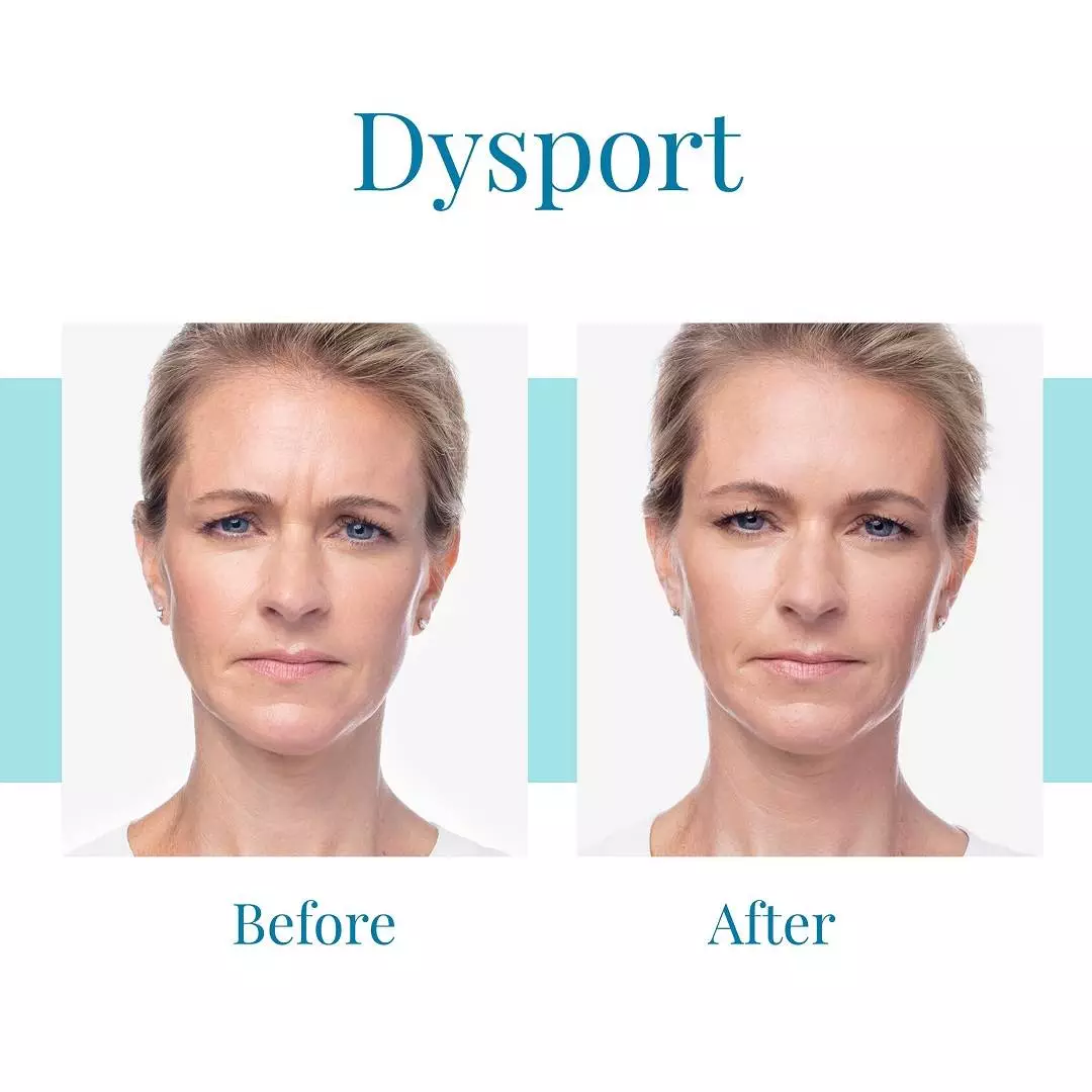 For-Dysport-injections-in-Alpharetta-trust-Bella-Medspa