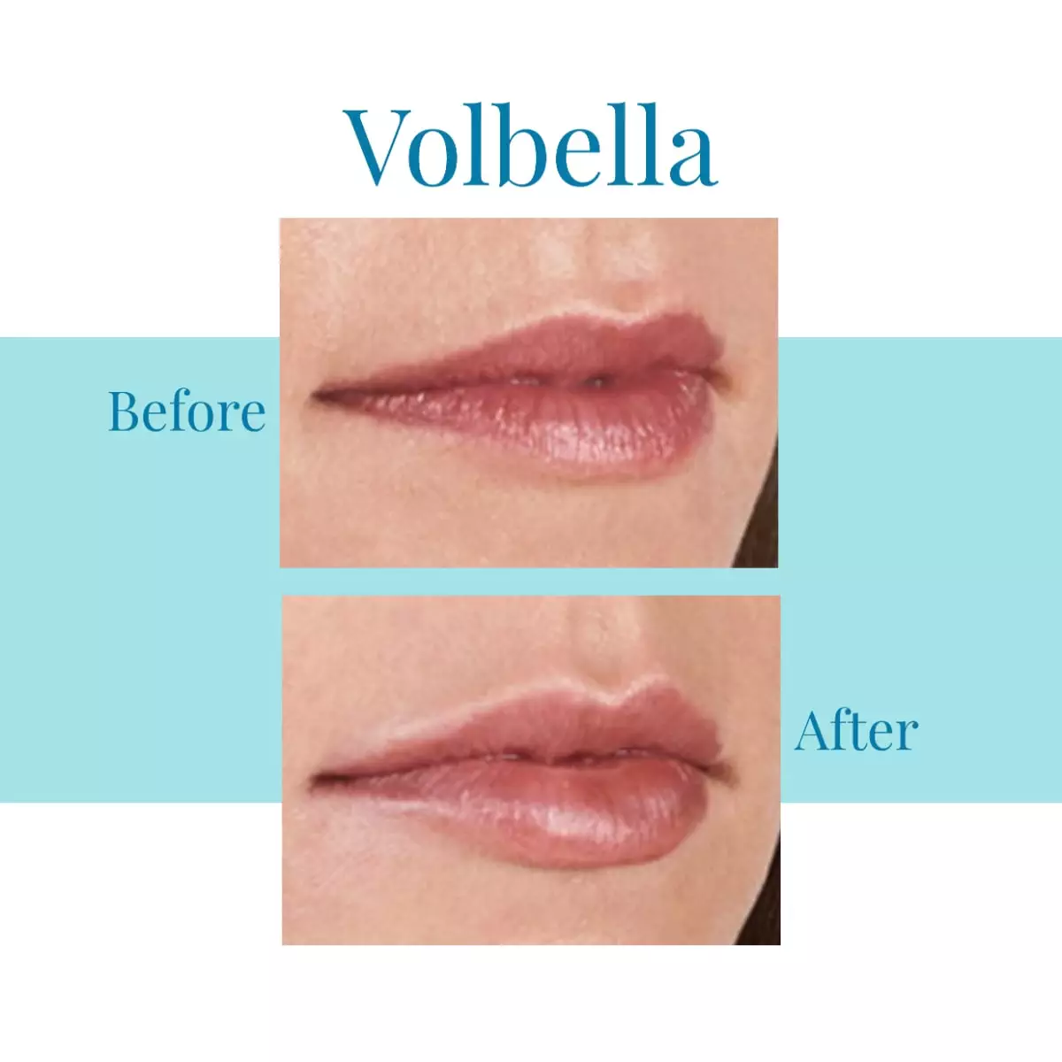 For-Juvederm-Volbella-in-Alpharetta-or-Buckhead-trust-Bella-Medspa