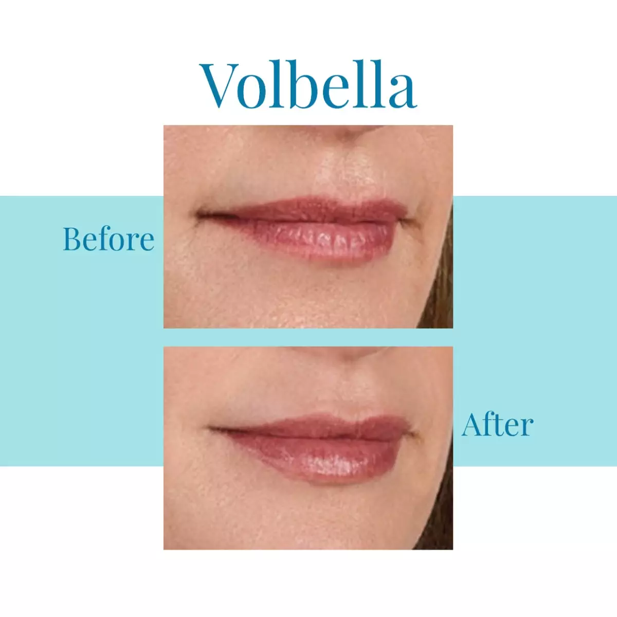 For-Juvederm-Volbella-in-Buckhead-or-Alpharetta-trust-Bella-Medspa