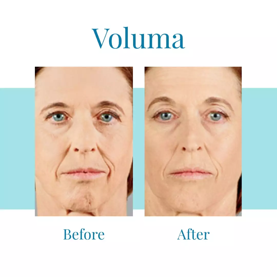 For-Juvederm-Voluma-in-Alpharetta-or-Buckhead-trust-Bella-Medspa