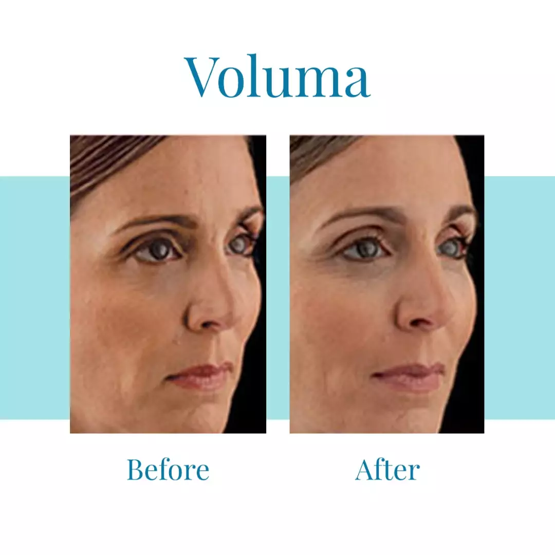 For-Juvederm-Voluma-in-Buckhead-or-Alpharetta-trust-Bella-Medspa