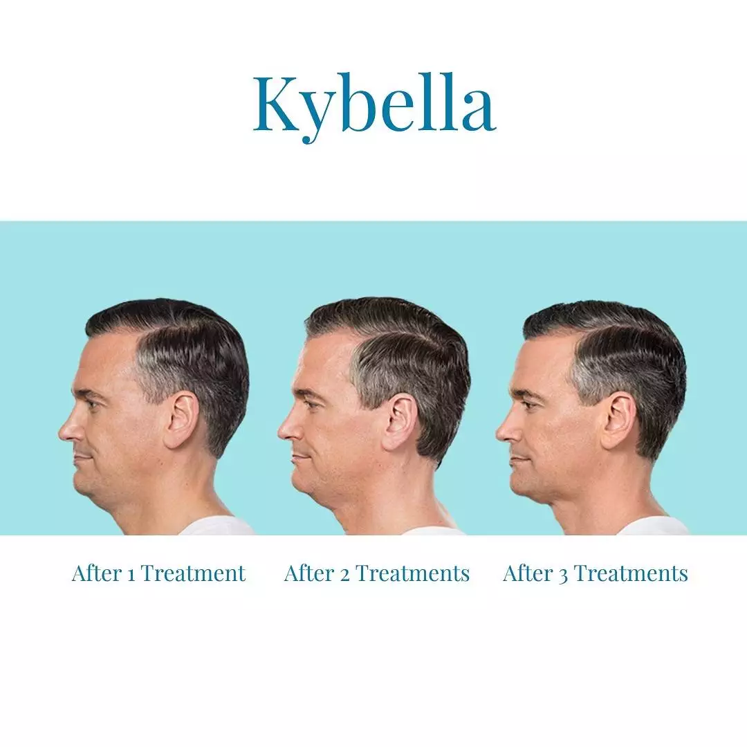 For-Kybella-in-Alpharetta-trust-Bella-Medspa