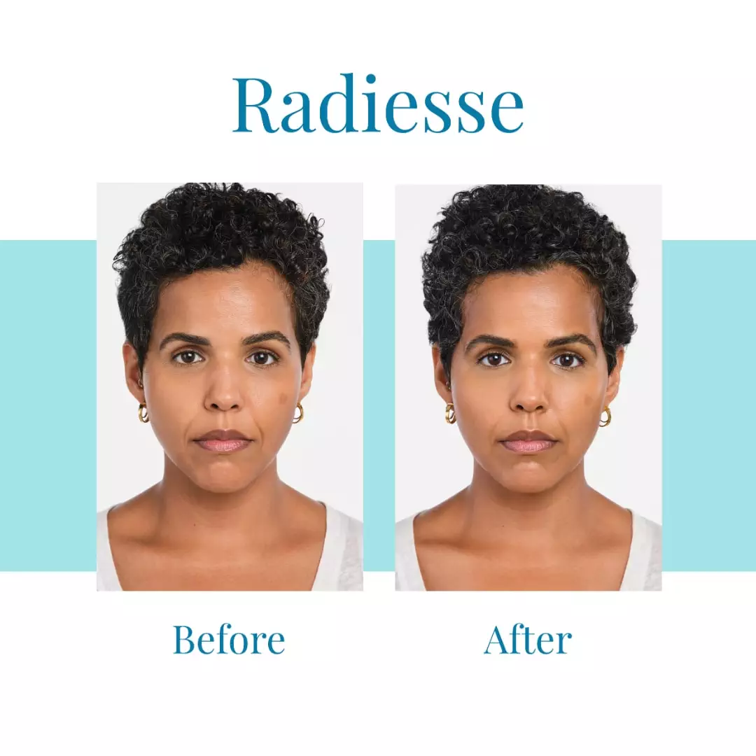 For-Radiesse-in-Buckhead-or-Alpharetta-trust-Bella-Medspa