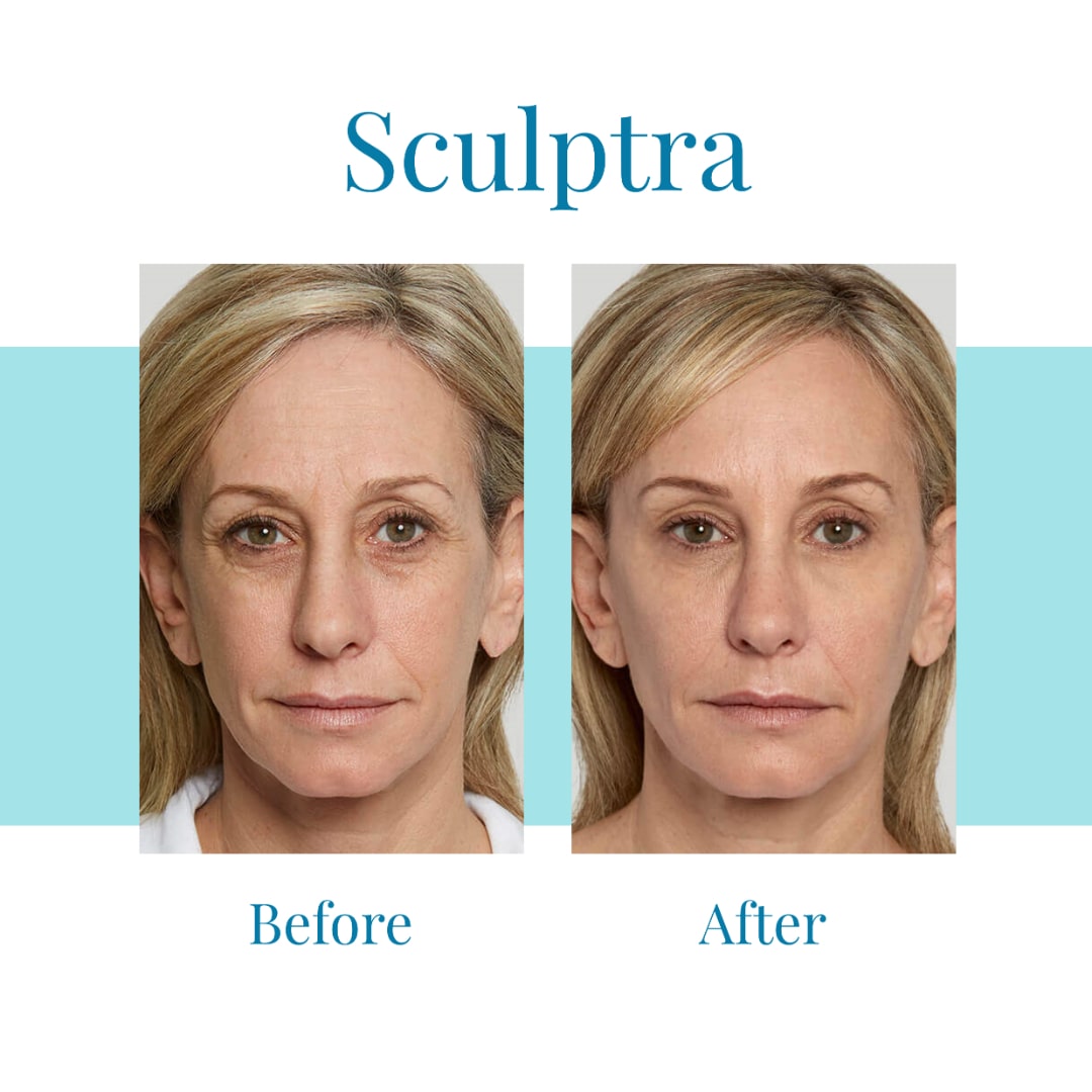 For-Sculptra-in-Alpharetta-or-Buckhead-trust-Bella-Medspa