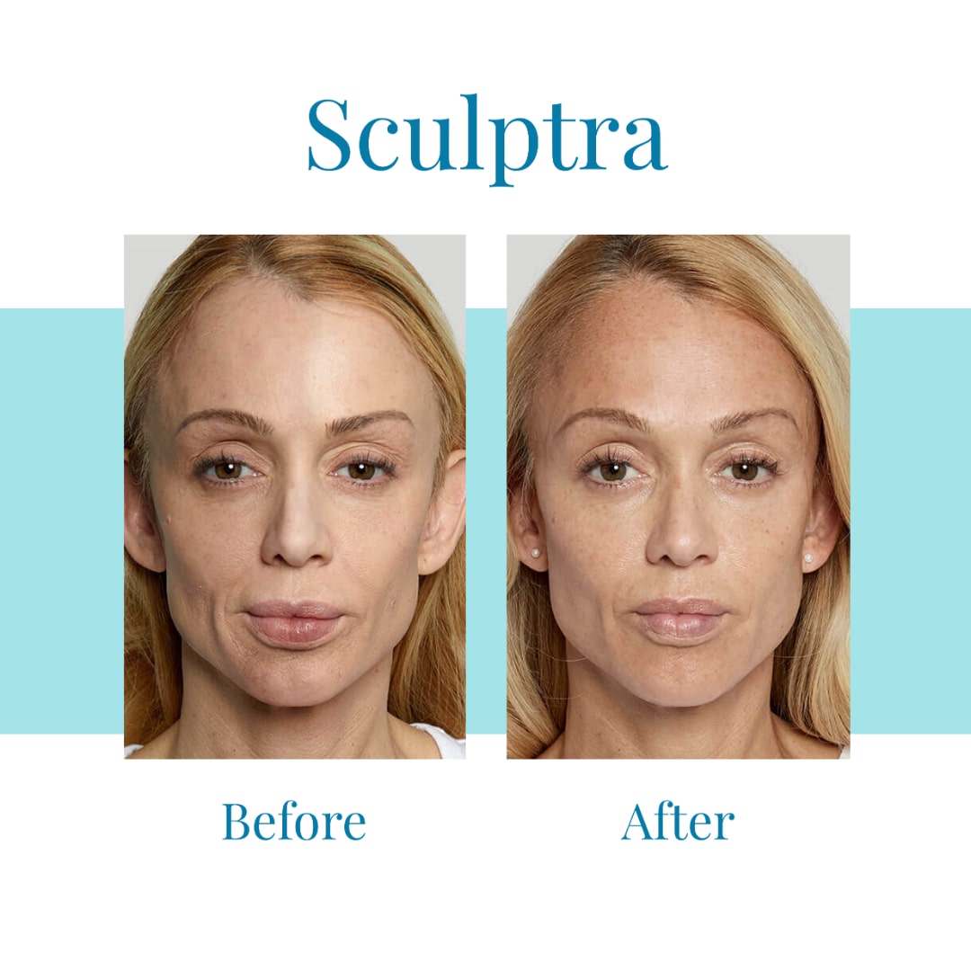 For-Sculptra-in-Buckhead-or-Alpharetta-trust-Bella-Medspa