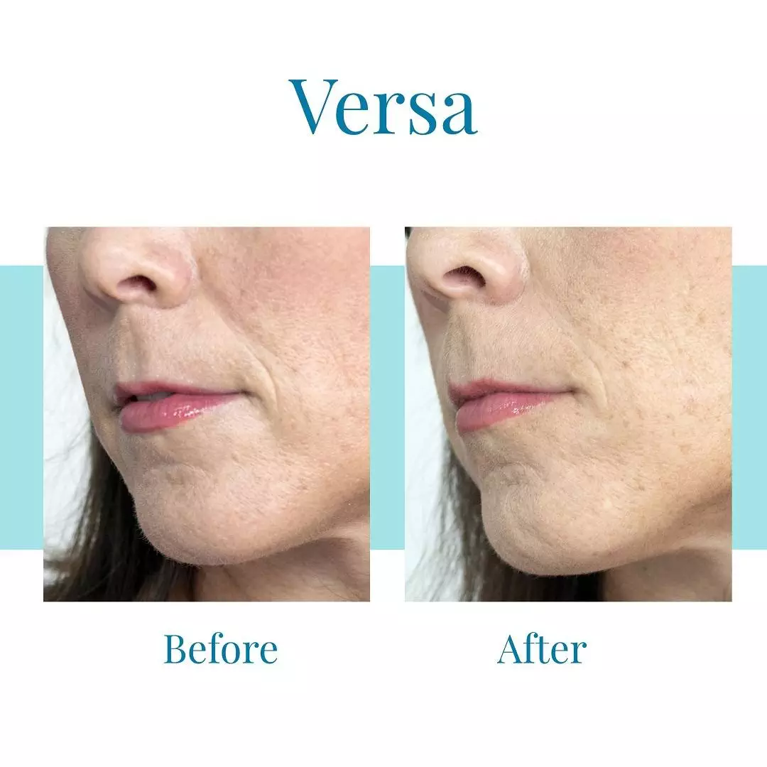 For-Versa-in-Alpharetta-trust-Bella-Medspa