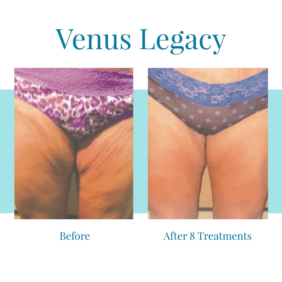 For the best Venus Legacy results in Alpharetta, turn to Bella Medspa