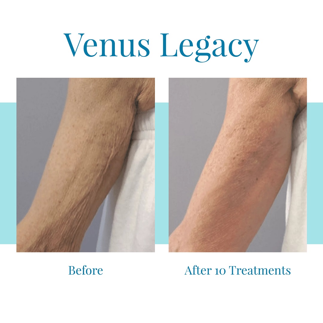 For the best Venus Legacy results in Atlanta, turn to Bella Medspa