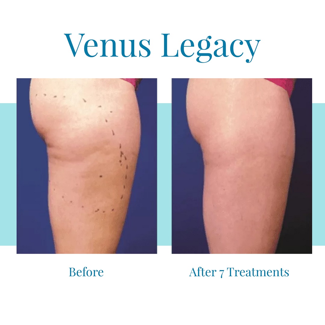 For the best Venus Legacy results in Buckhead and Alpharetta, turn to Bella Medspa