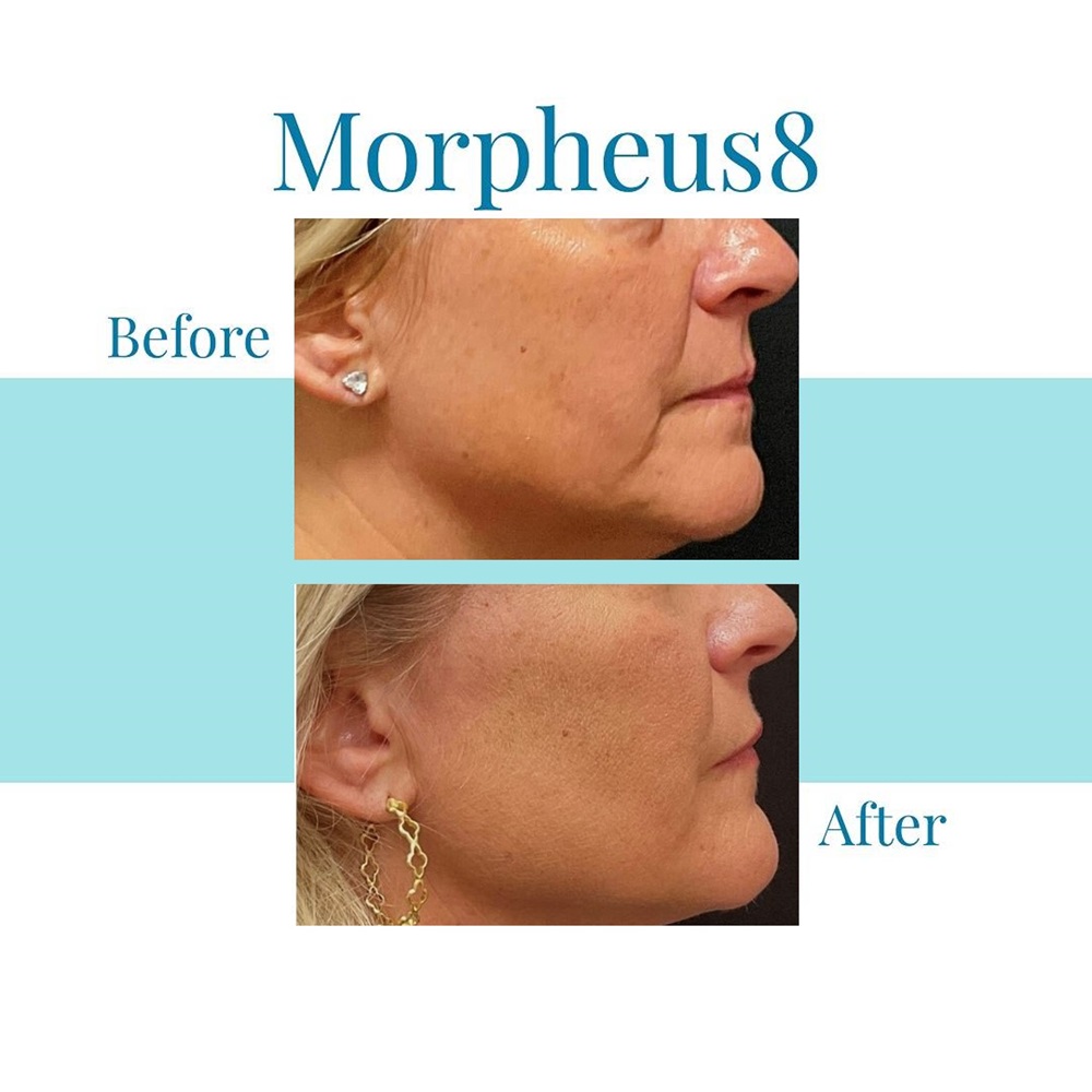 Bella Medspa is the top provider of Morpheus8 in Alpharetta