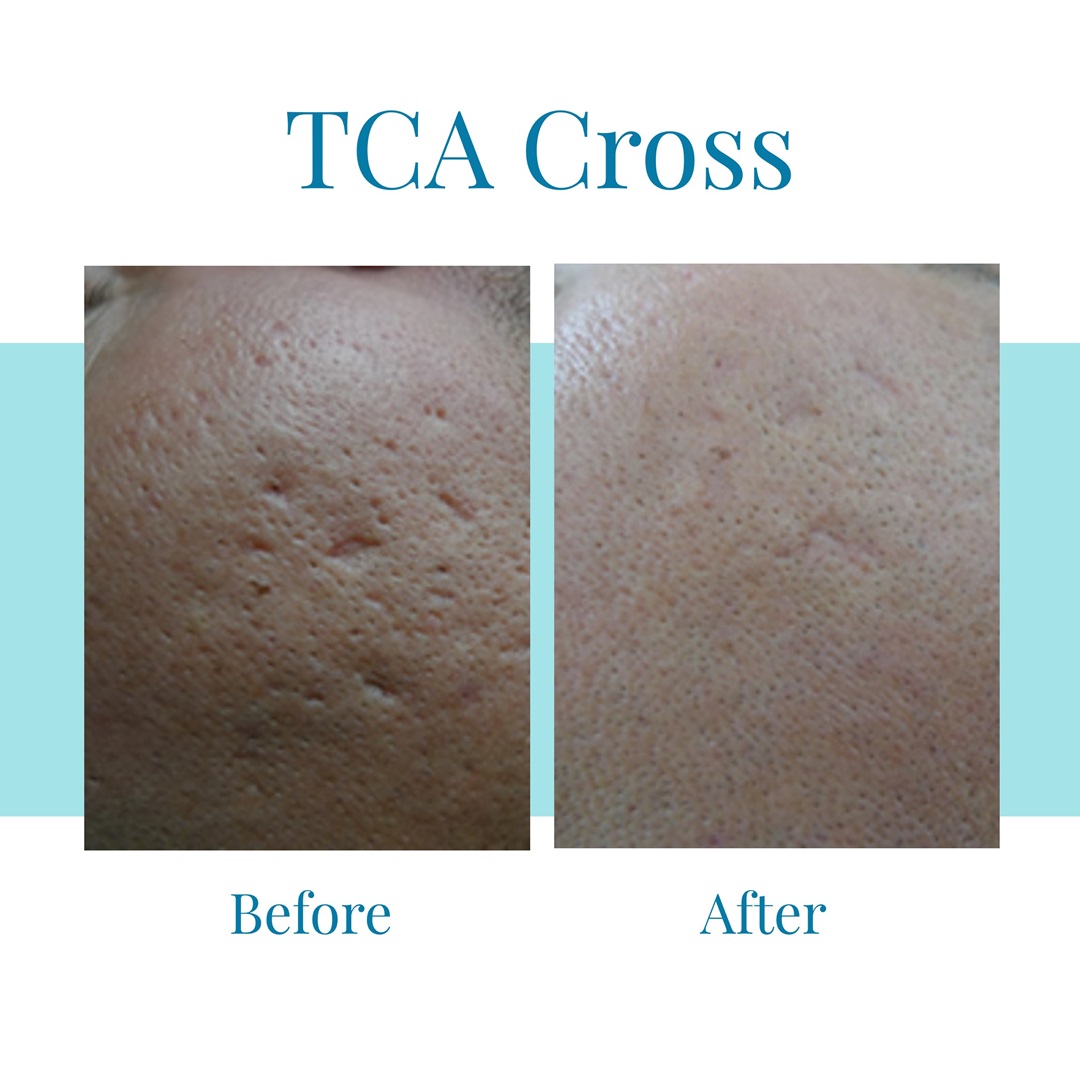 TCA Cross B&A 2