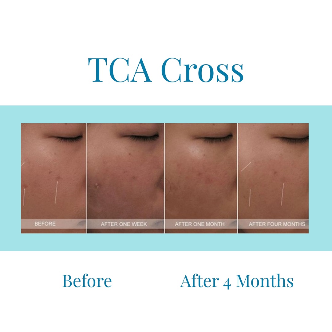 TCA Cross B&A 3